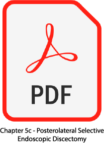 PDF Icon for Chapter 5c Posterolateral Selective Endoscopic Disectomy